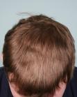 After Hair Transplant&nbsp;Hairlines